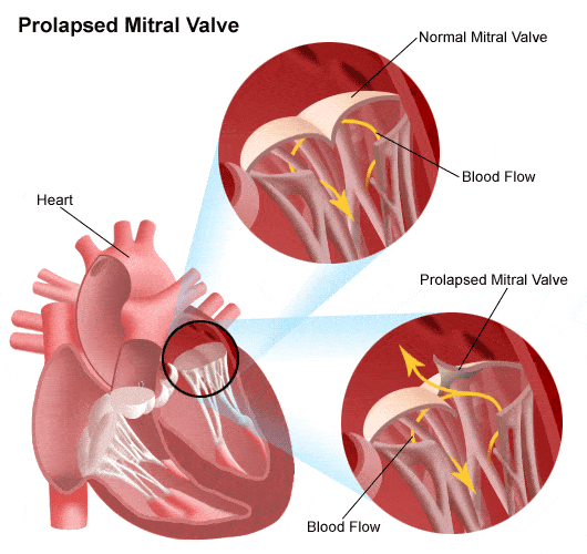 Mitral Valve Prolapse Surgery