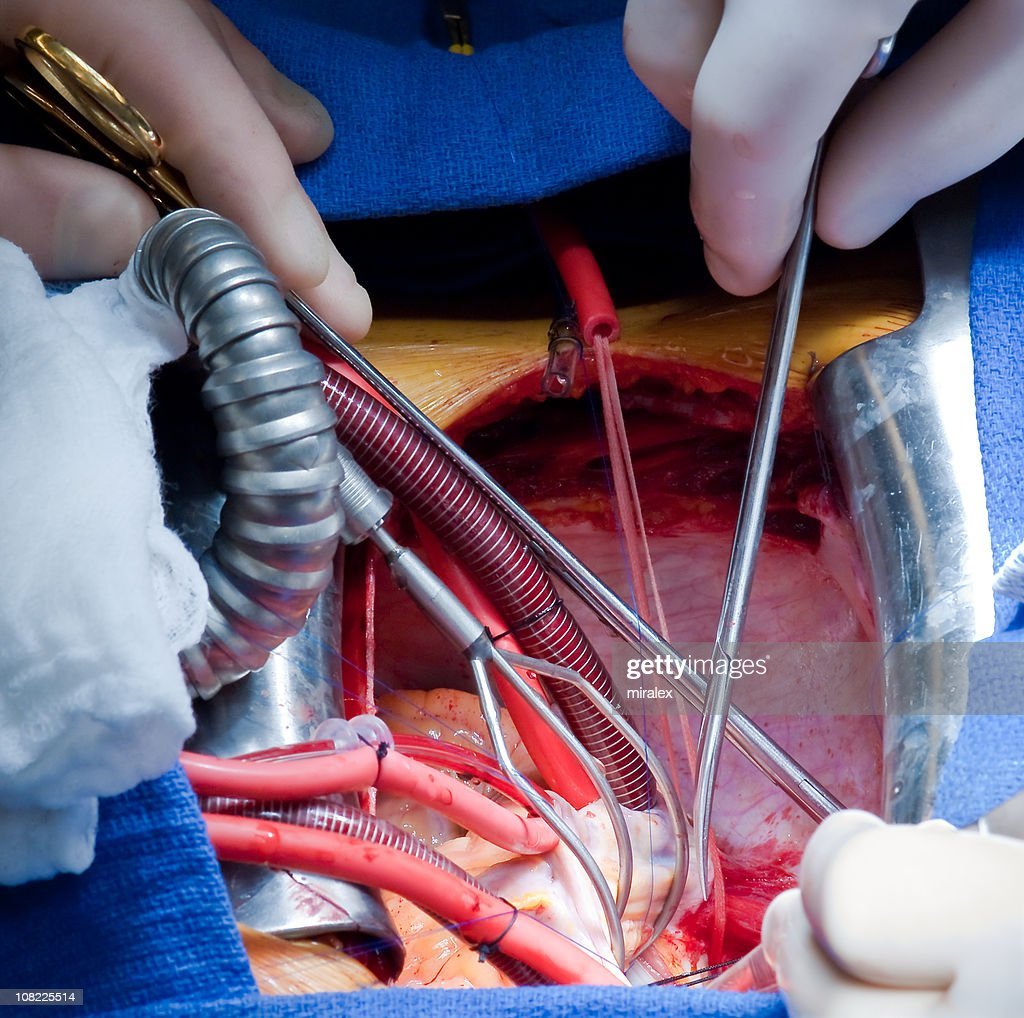Mitral Valve Repair Heart Surgery High