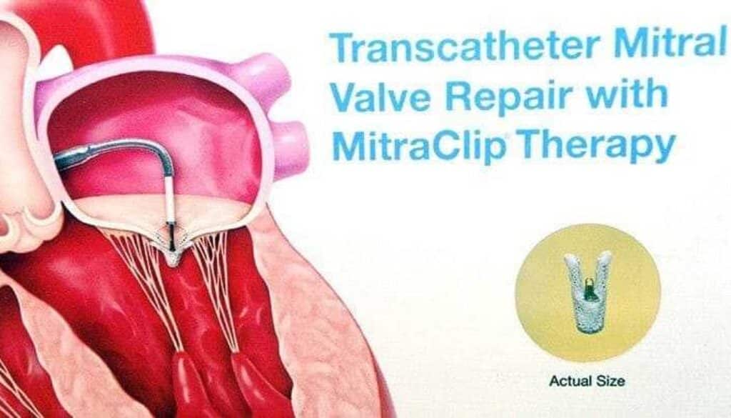 Mitral Valve Replacement in Hyderabad Without Surgery