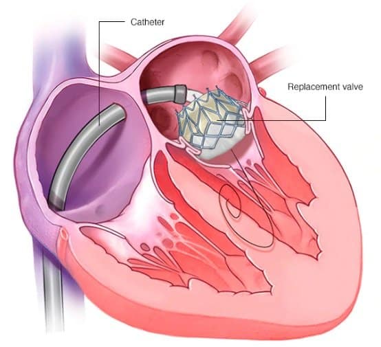 Mitral Valve Replacement Open Heart Surgery