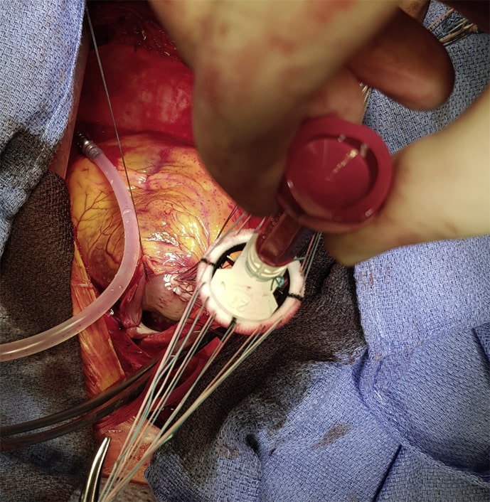 Mitral valve replacement through left atrial appendage 28 years after ...