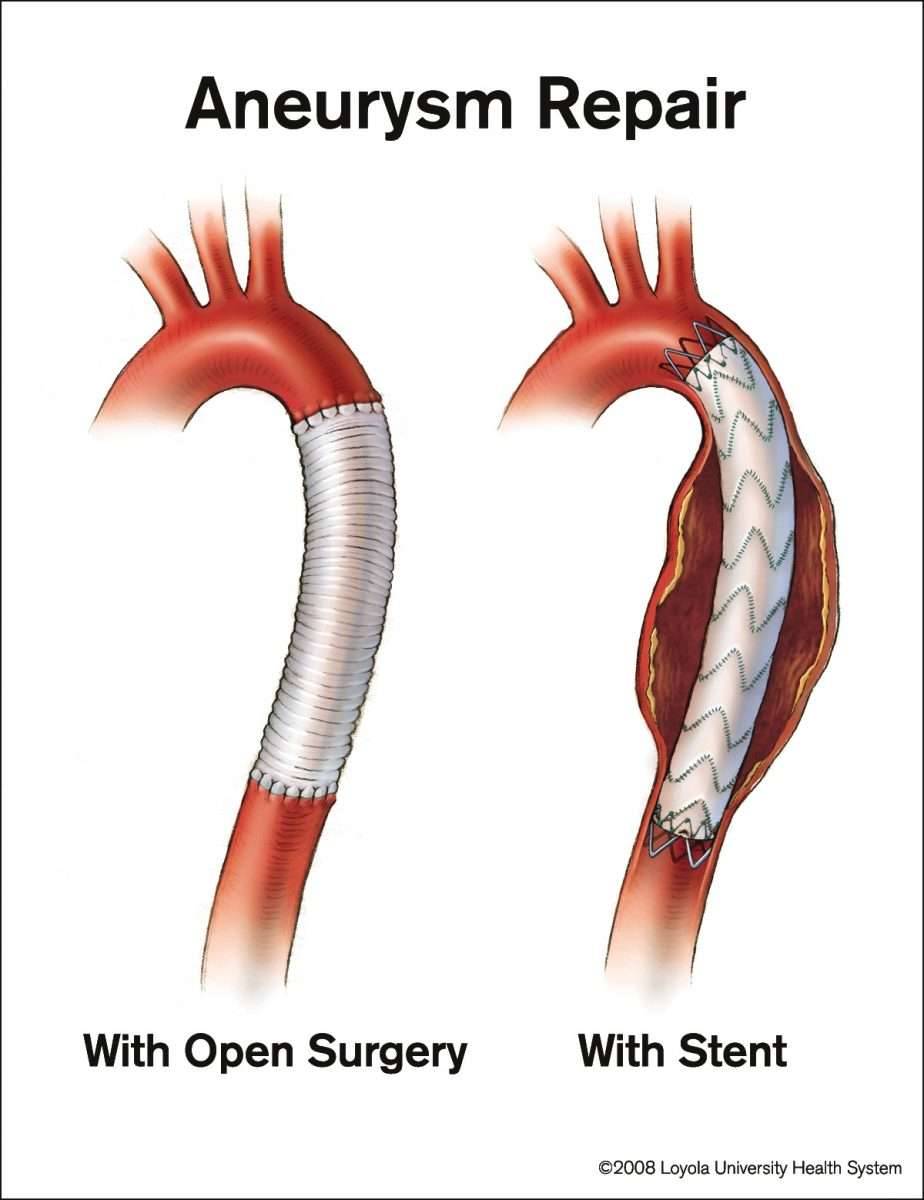 More Aortic Aneurysms Being Treated With Stents