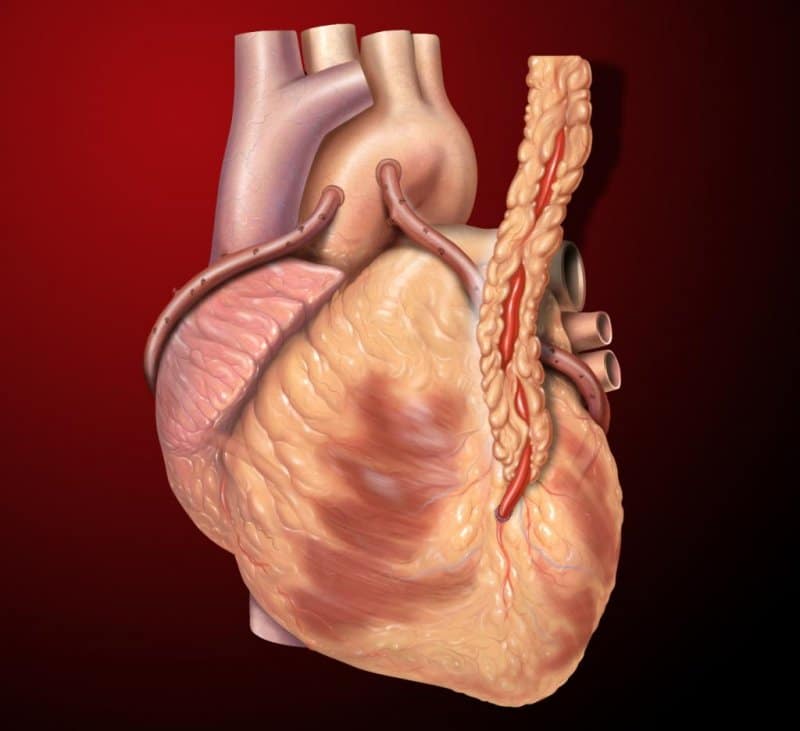 Open heart surgery better than stents for multivessel disease, study ...