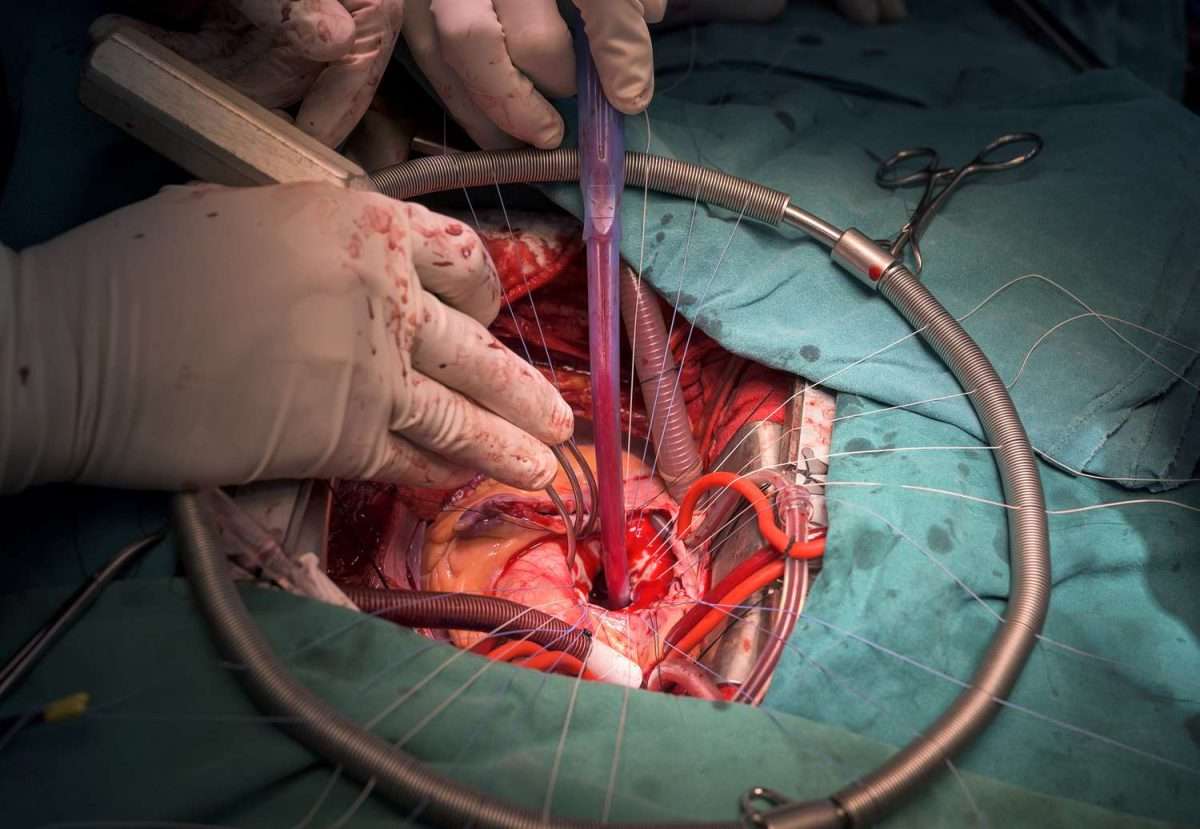 Open Heart Surgery: Overview