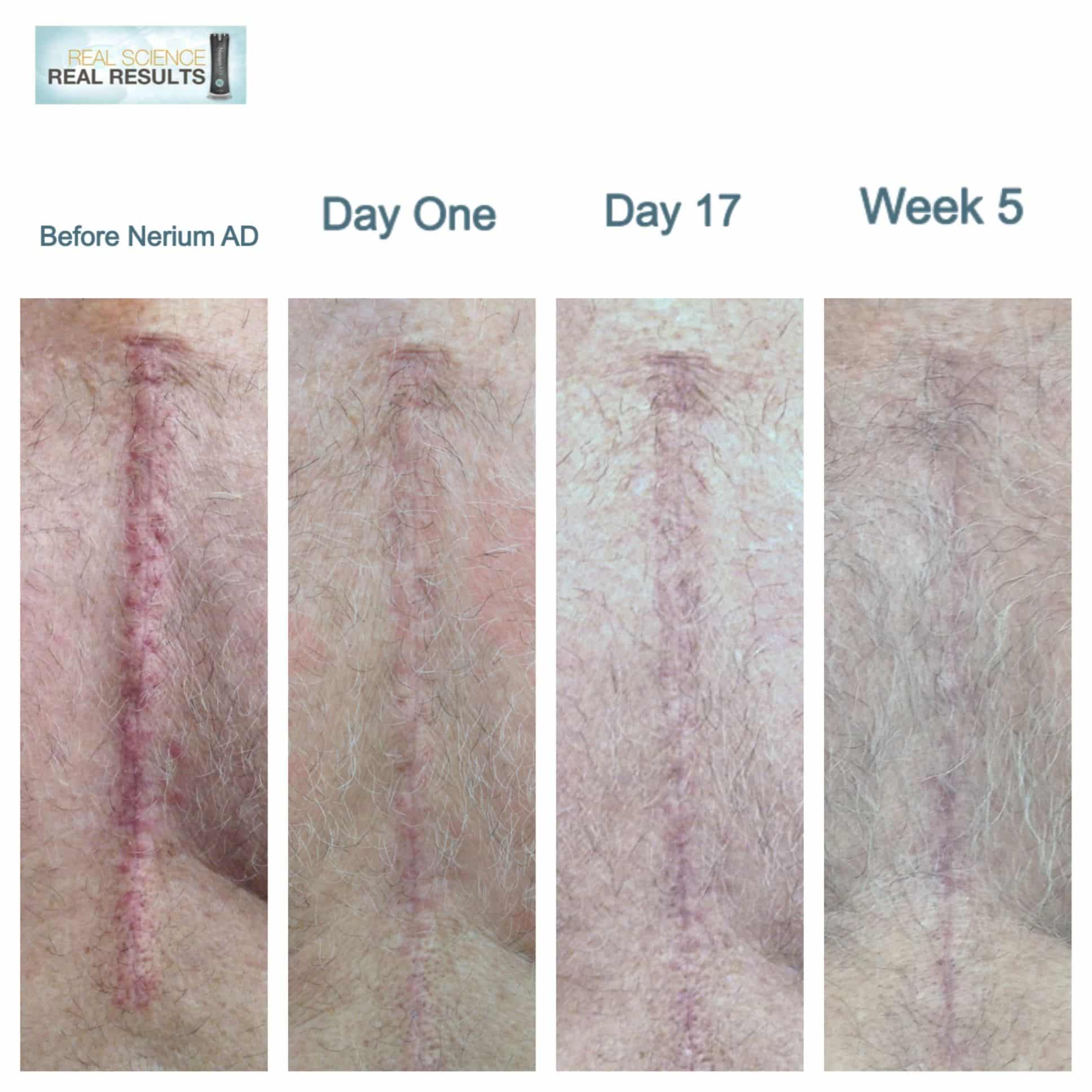 Open heart surgery scar vanishes with continued use of NeriumAD. Works ...