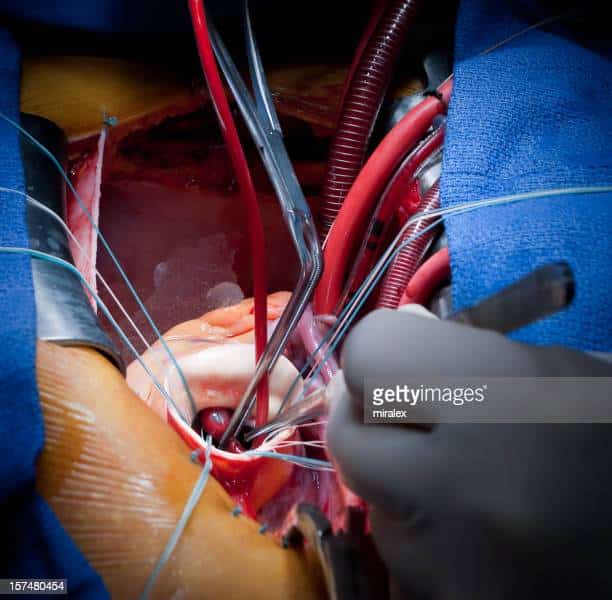 Open Heart Surgery Stock Photos and Pictures