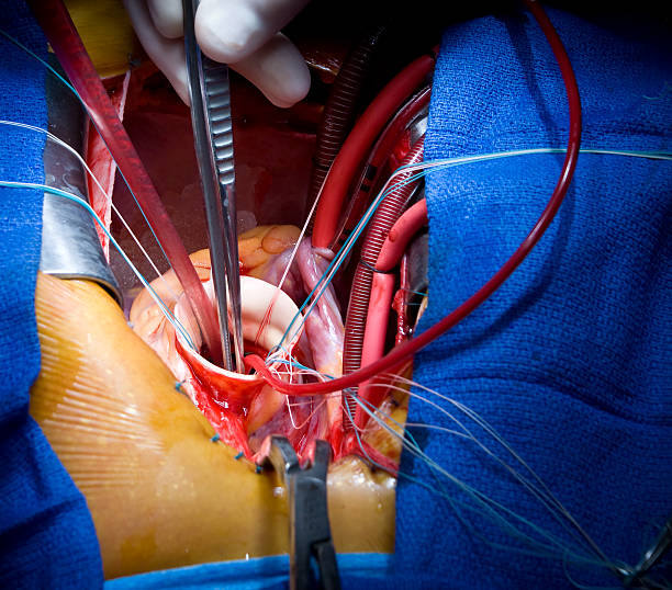 Open Heart Surgery Stock Photos, Pictures &  Royalty