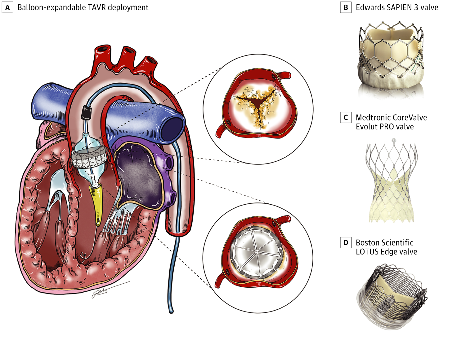 Outcomes of Transcatheter Aortic Valve Replacement in Patients with ...