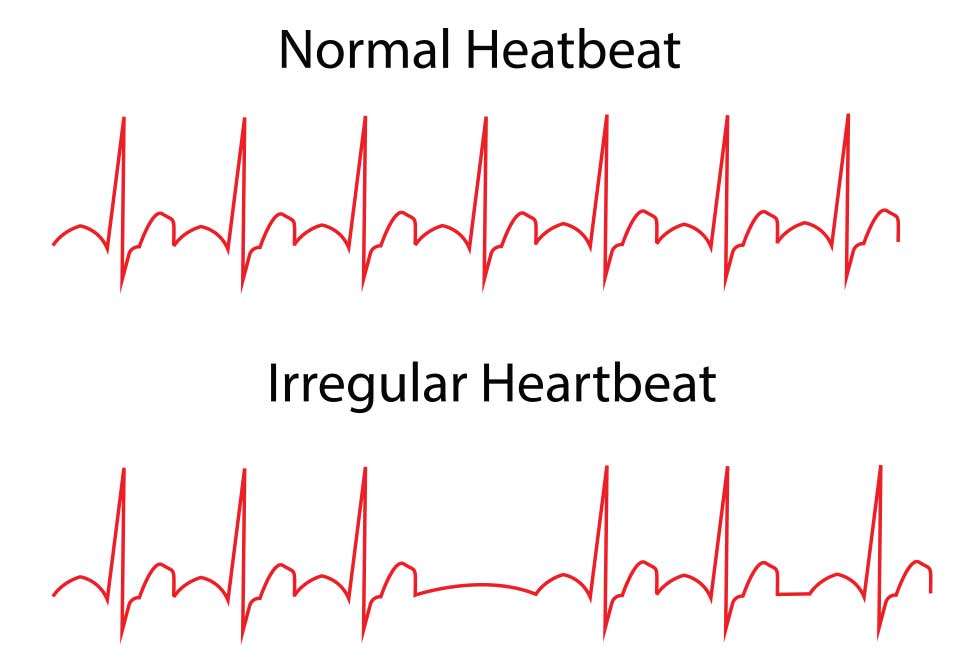 Overview of Arrhythmias