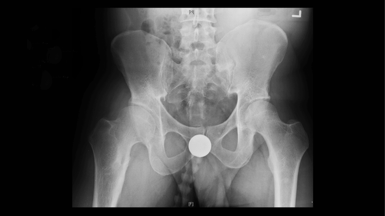 Periacetabular Osteotomy for Complex Structural Hip Deformity ...