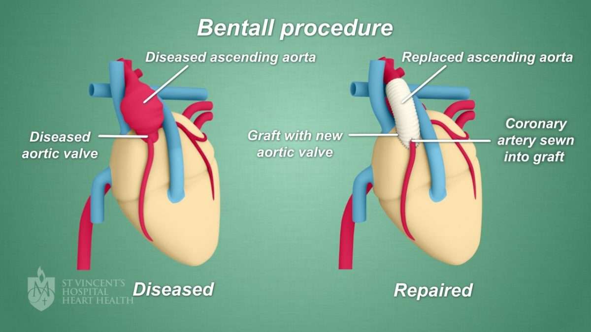 Physical Limitations After Aortic Valve Replacement