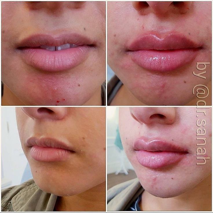 Pin on Lip injections