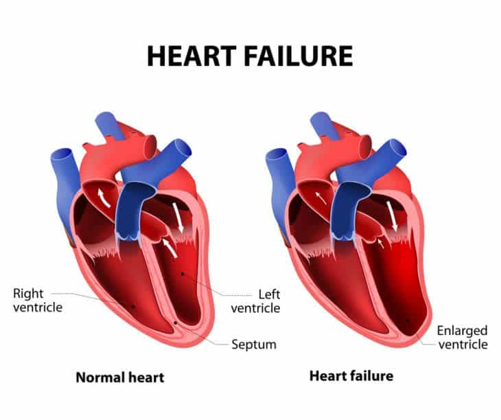 Pumping Out Common Types and Symptoms of Heart Failure