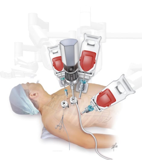 Robotic Mitral Valve Surgery
