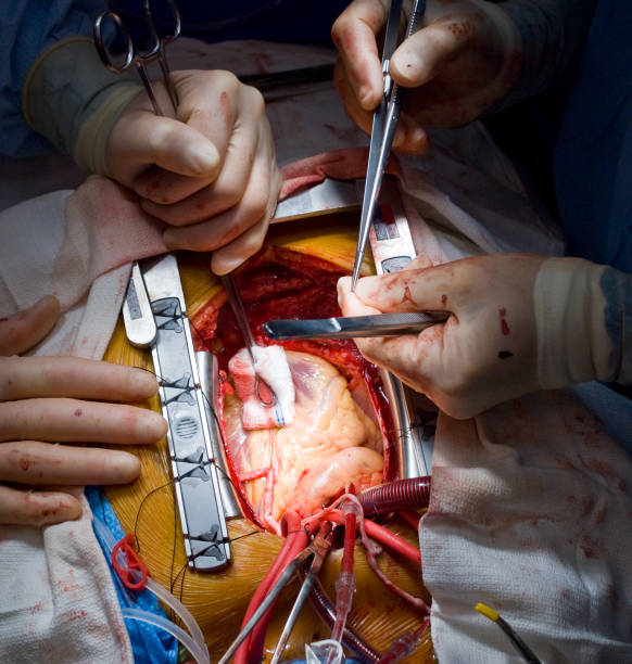 Royalty Free Heart Bypass Surgery Pictures, Images and Stock Photos ...