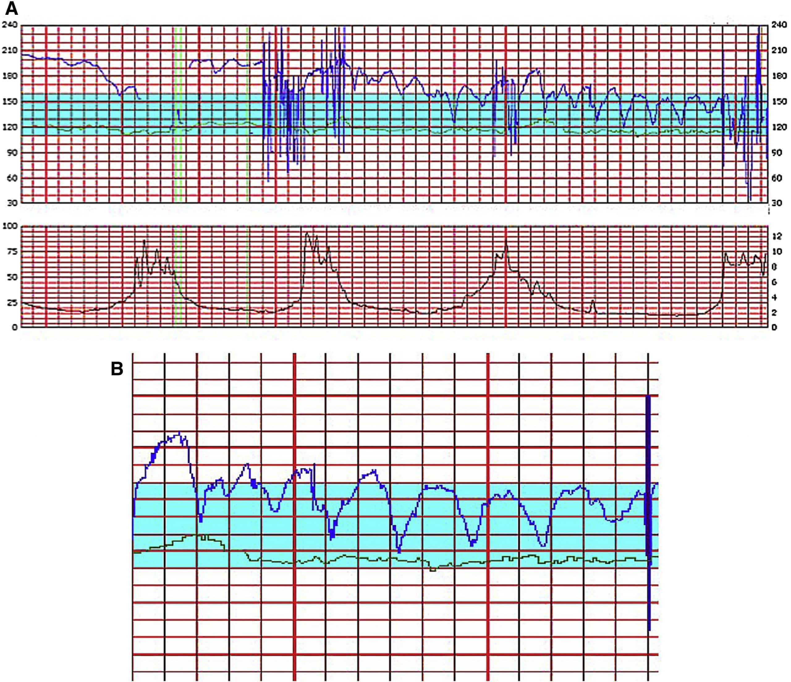 Sawtooth fetal heart rate pattern due to in utero fetal central nervous ...