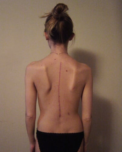 Scoliosis post surgery scar