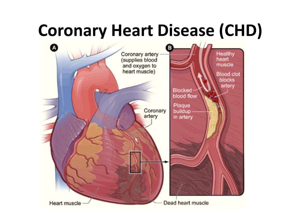 Silent Ischemia: Heart disease