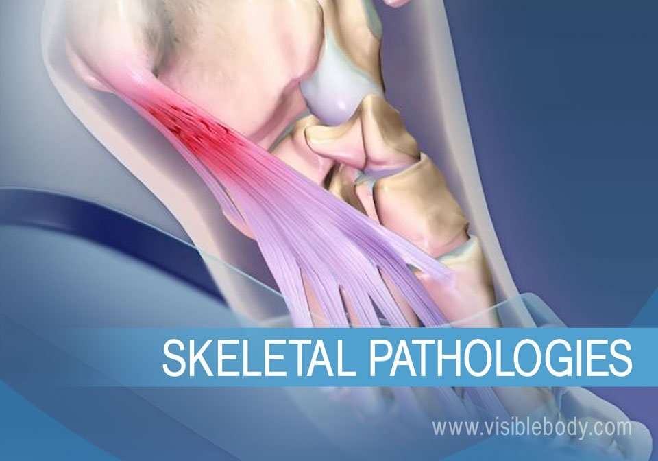 Skeletal System Pathologies