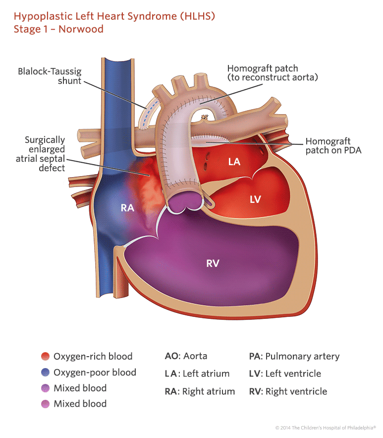 Staged Reconstruction Heart Surgery