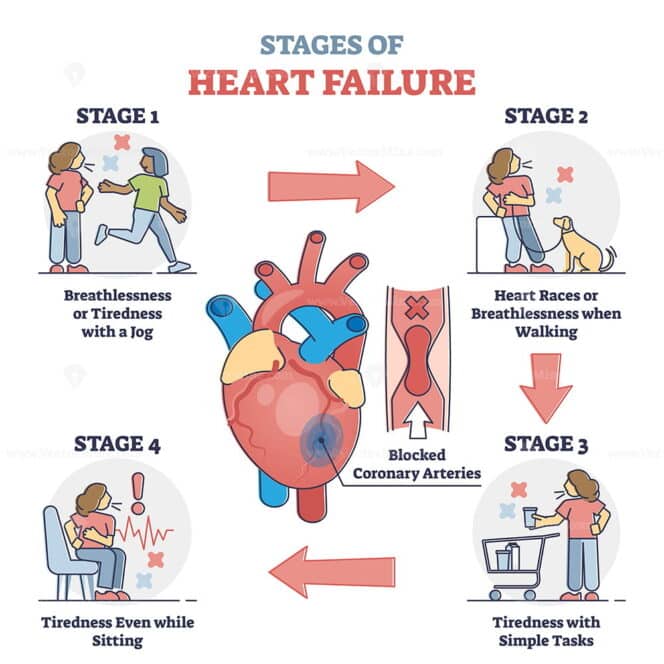 Stages of heart failure and symptoms with cardiology stroke outline ...
