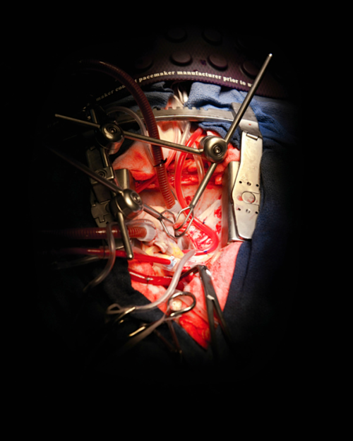 The 25+ best Open heart surgery ideas on Pinterest