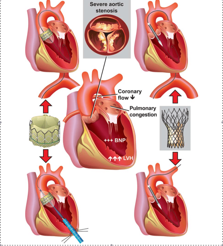 Trans catheter aortic valve implantation (TAVI)