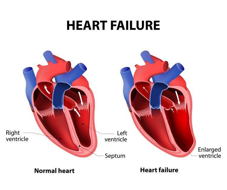 Understanding Heart Failure in the Elderly