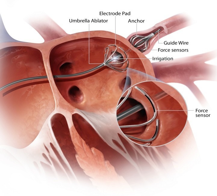US Patent Office allows AblaCor five ablation catheter