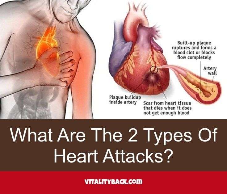What are the 2 types of heart attacks? Follow the link to get more ...