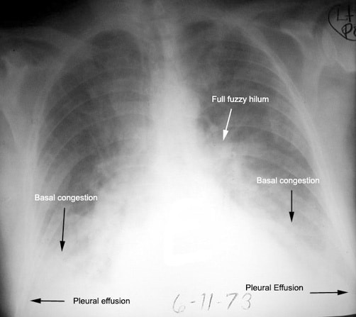 What are the findings of heart failure seen in this chest x