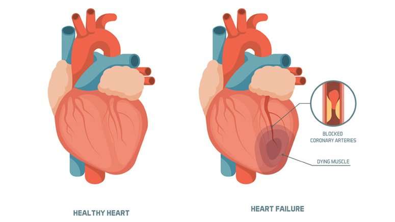 What Are the Four Stages of Congestive Heart Failure?  Entirely Health