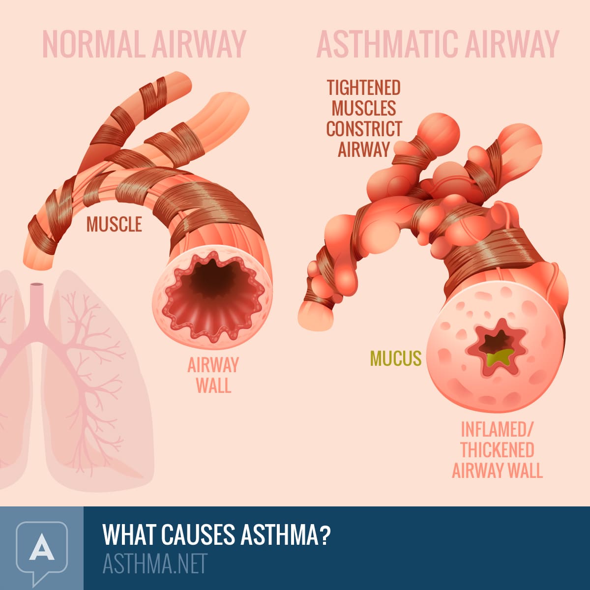 What Causes Asthma: Inflammation and Airway Narrowing