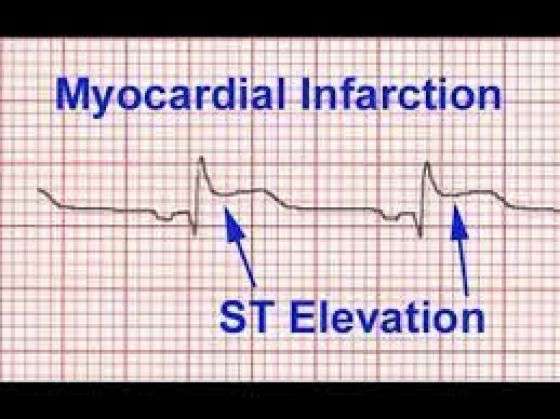 What Does an EKG Look Like In a Heart Attack With Pictures ...