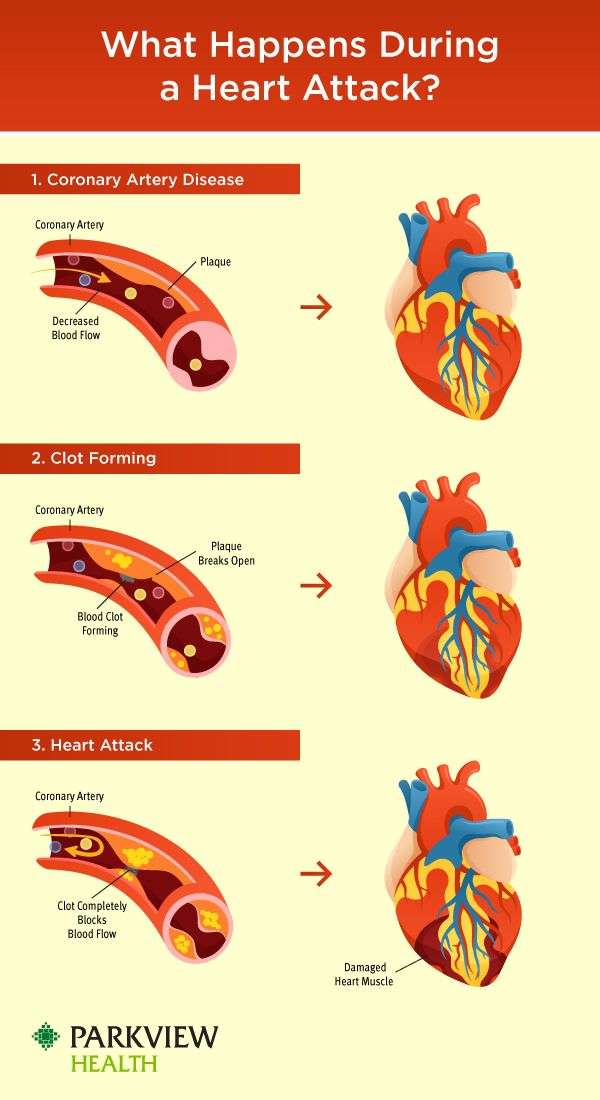 What happens during a heart attack? in 2021