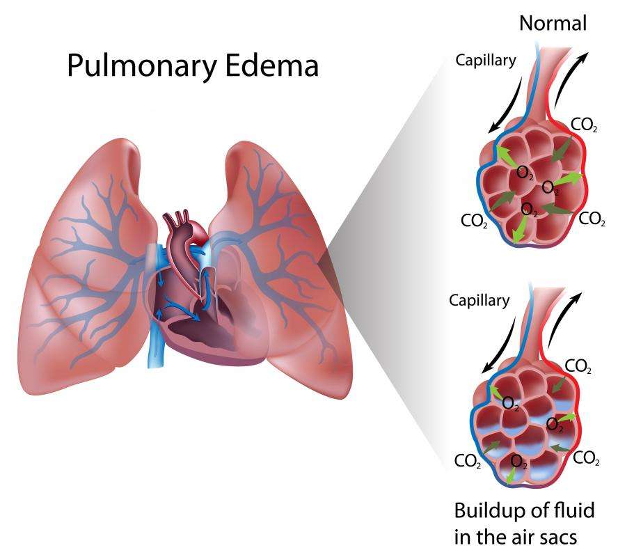 What is the Connection Between Edema and Congestive Heart Failure?