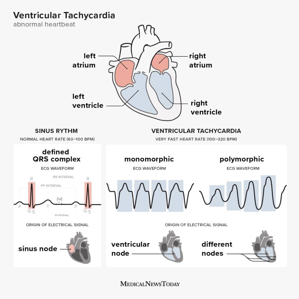 What is ventricular tachycardia? Types, symptoms, treatment