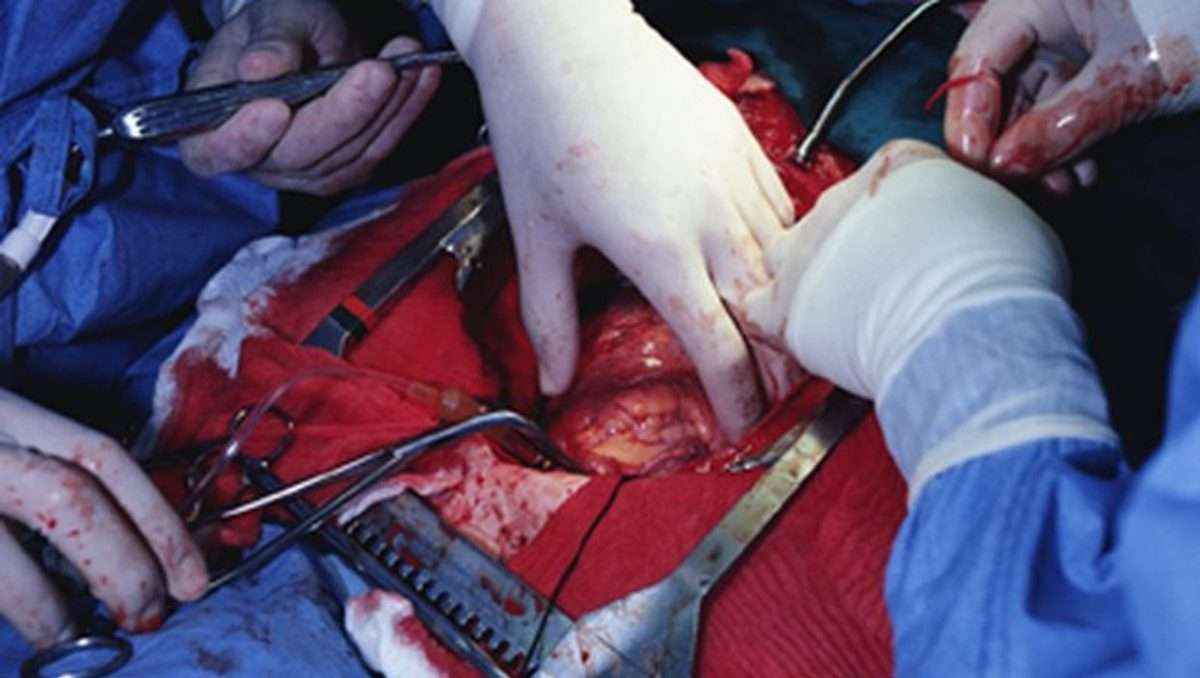 Which Heart Bypass Surgery Works Best?