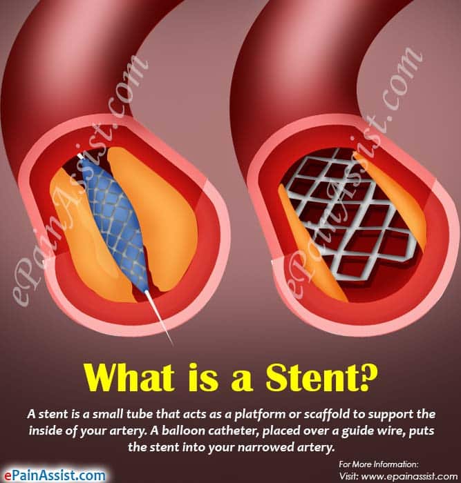 Who is a Good Candidate for Angioplasty and Stent Placement &  How is ...