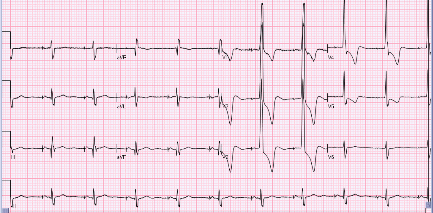 Would Heart Disease Show Up On An Ecg